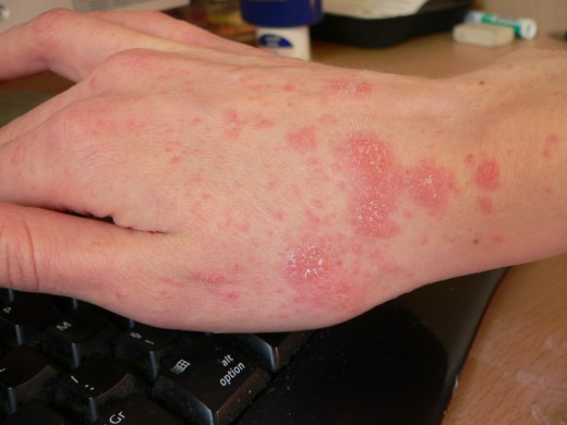 Scabies on the hand.