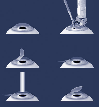 Lasik Surgery