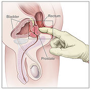 Fig. 5: Digital Rectal Exam (Wikipedia, 2009).