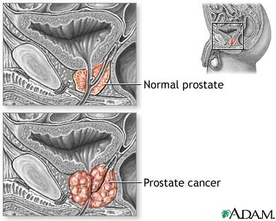 Fig. 4: Normal Prostate (A) and prostate cancer (B). In prostate cancer, the regular glands of the prostate are replaced by irregular glands and clumps of cells. http://www.healthprofessor.com/encyclopedia/hp_other/prostate_c