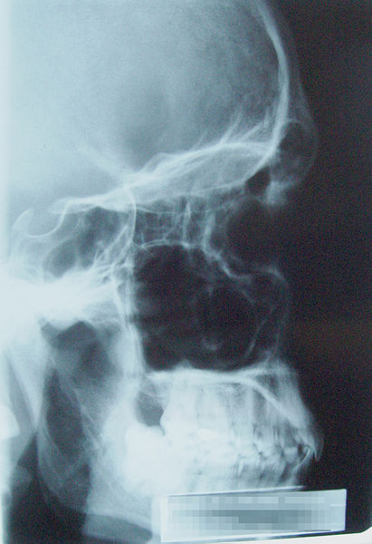 X-ray image of the paranasal sinuses  Source: Wikipedia 