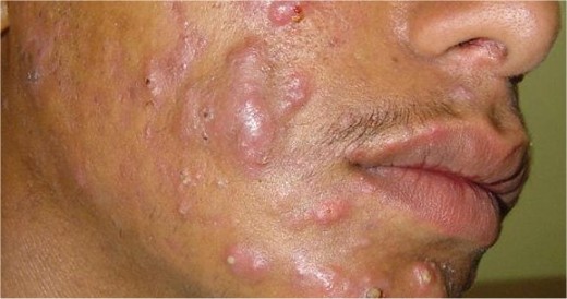 acne conglobata