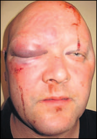 Happy Clampers!  The face of clamper, Jason White, from Whites Car Park Solutions, after enraged victims attacked him with iron bars.  I'd be looking for another job, Jayce!  photo by dailyecho.co.uk