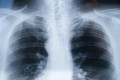 The History of Asbestos and Mesothelioma Today, with Videos