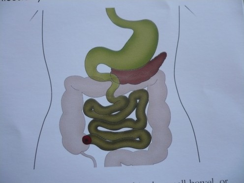 This diagram shows how an ileostomy is surgically made. Part of the terminal ileum (last section of small bowel) to form a stoma. Then it is brought through the abdominal wall, everted to form a spout and sutured to the skin. The output consistency w