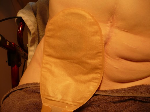 An ileostomy bag is called a pouch. Its unique design makes it comfortable to wear and minimises the risk of leakage. This is important for an ostomate, which is an affectionate name for a person with an ileostomy.