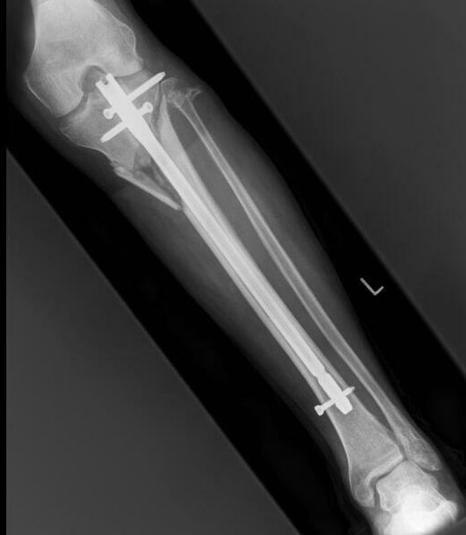 A repaired tibia.