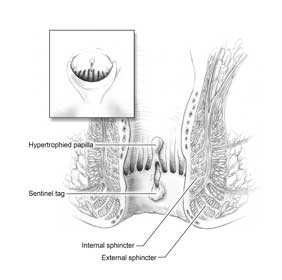 anal fissure