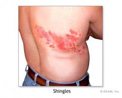 Is There a Shingles Vaccine?