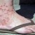 Nasty red spots of chigger attack.  Makes you wonder how they weren't spotted before they became "spotted!"    freegolfinfo.com photo