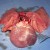 Heart with enlarged Right ventricle and atrium resulting in heart failure. Heart with enlarged Right ventricle and atrium resulting in heart failure.