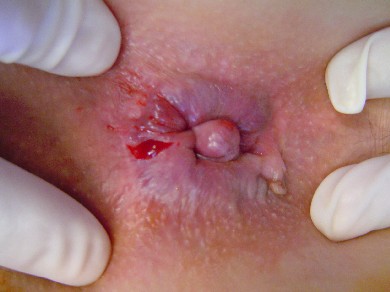 anal fissure