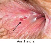 anal fissure
