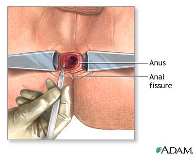 operation for anal fissure internal sphincterotomy