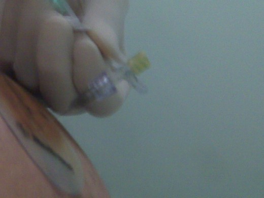 Doctor injecting a needle thru the skin directly into the center of the pump
