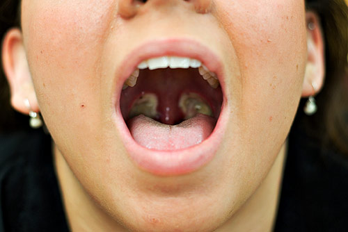 adult-tonsillectomy-recovery-hubpages