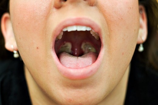 Adult Tonsillectomy Recovery | hubpages