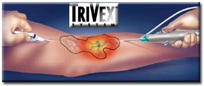 Learn how surgeons use TriVex to illuminate the veins for varicose veins treatment.