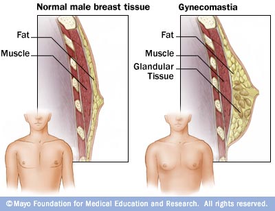 Normal male breasts versus Gynecomastia condition