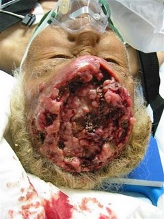 Shota Fujiwara's head after had been surgical cut http://karakoza.blogspot.com 