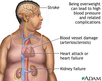 Obesity increases a person's risk of illness and death due to diabetes, stroke, coronary artery disease, hypertension, high cholesterol, and kidney and gallbladder disorders. (From: Obesity and Health)