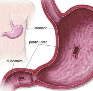 Peptic ulcer