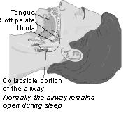 http://www.columbusdentistry.com/images/apnea.jpg