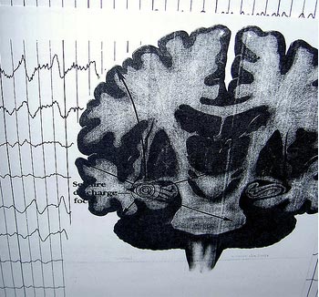 Complex Partial Seizure Brain Scan