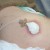 PLace a strip of stomi paste about 1cm away from the edge of the wound where the drain will exit the wound bed and suction dressing.This is to both avoid any pressure wound developing from the drain tubing and also to ensure that the dressing will be PLace a strip of stomi paste about 1cm away from the edge of the wound where the drain will exit the wound bed and suction dressing.This is to both avoid any pressure wound developing from the drain tubing and also to ensure that the dressing will be