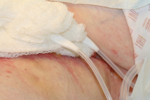 The drains exited at the top of the leg