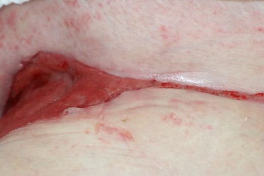 This is the same wound after 16 weeks of continuous treatment. The wound was finally closed with a skin  graft fixed by negative pressure.