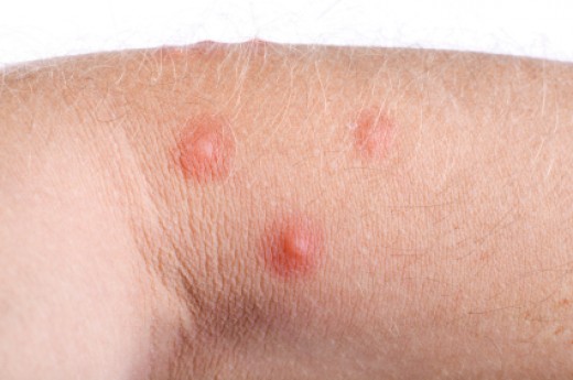 What are some different types of rashes?