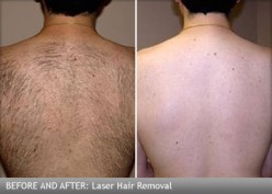 Choosing a Laser Hair Removal School