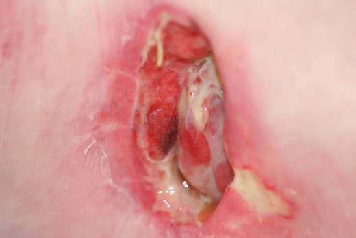 This wound started as a burning sensation on the skin, within 2 days it had developed to an open purulent wound. Luckily this woman came to the ER as she had high fever and was feeling sick, she mentioned the burning sensation and treatment was start