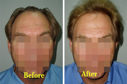 Hair transplantation is one of the most popular male plastic surgery procedures.