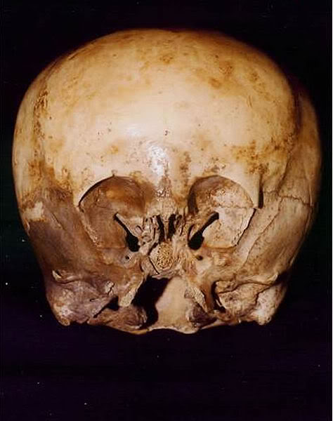 Starchild skull