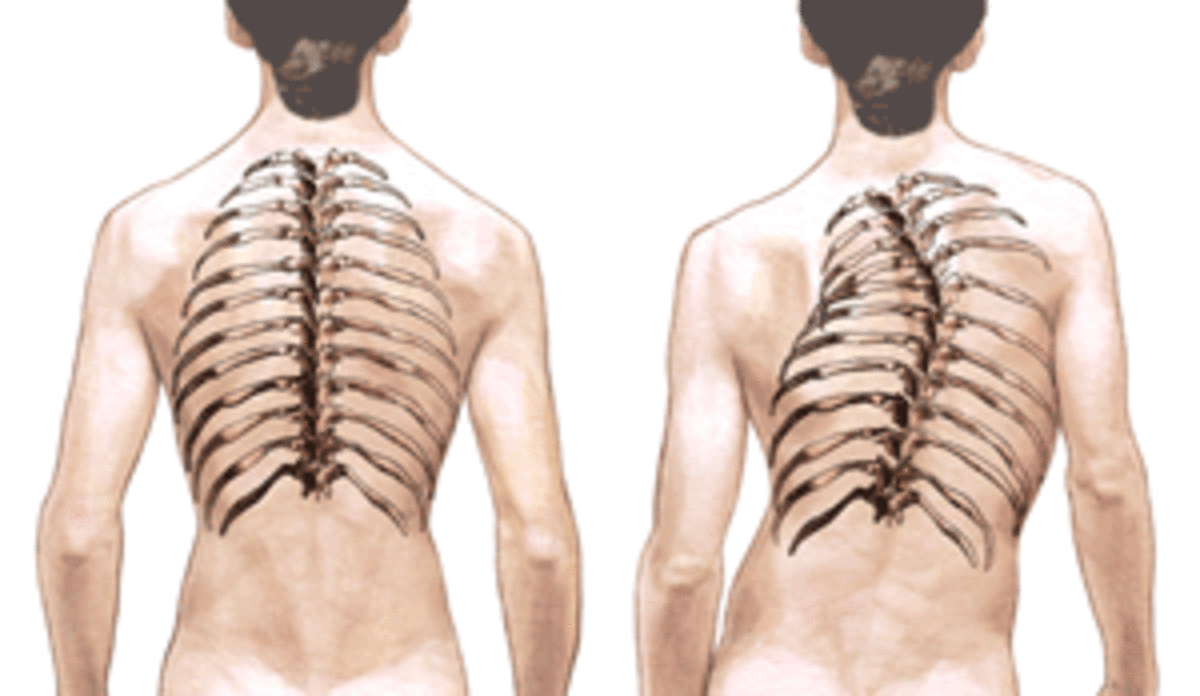 Figure 1. An illustration of scoliosis (captured from http://www.bridwell-spinal-deformity.com/photos/spine_path/scoliosis_illus100.gif)