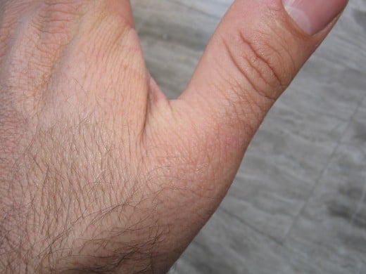 Hardly noticeable trace of the wart just behind the knuckle.