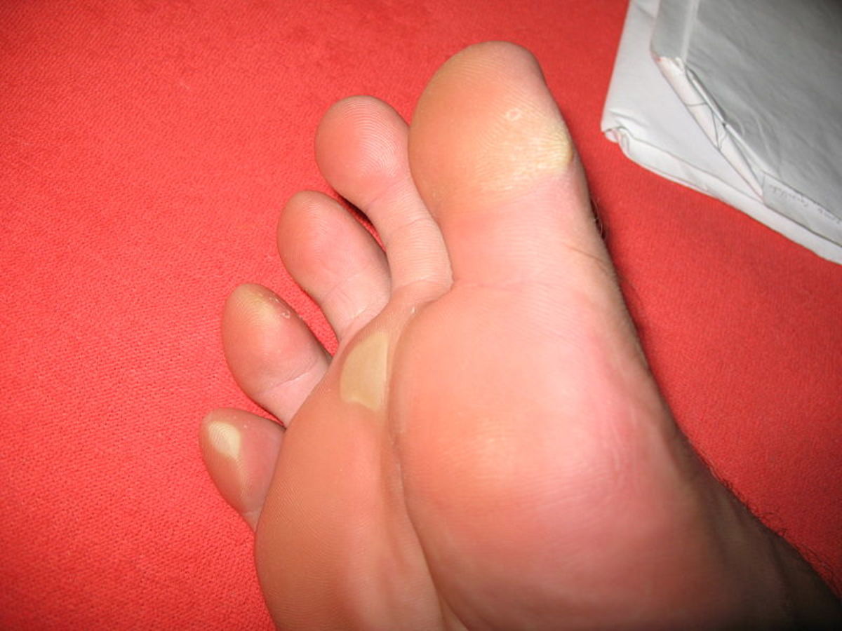 How To Remove Corns or Calluses From Your Feet 
