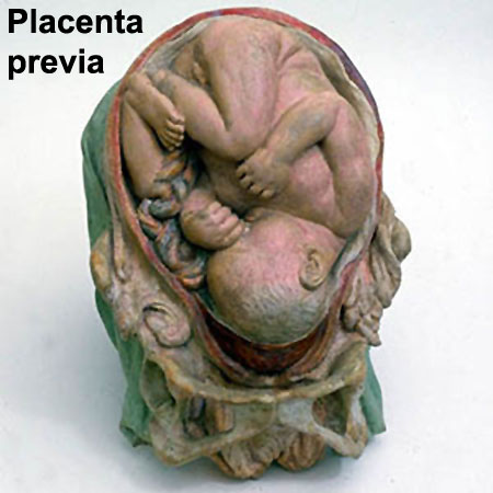 A placenta previa is a condition where the placenta is obstructing the opening of cervix sometimes causing miscarriage or abortion.