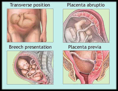 Positions of placenta previa