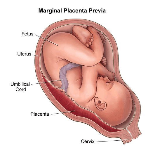 Vaginal bleeding is experienced because of placenta previa during pregnancy.