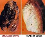 On left a lung with emphysema; on right healthy lung