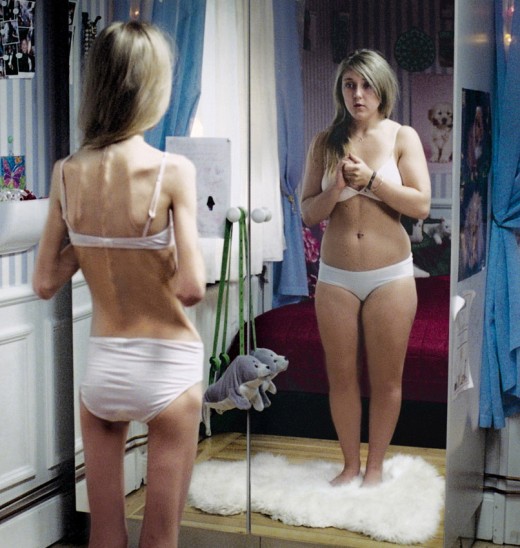 Anorexia is an extreme fear of gaining weight and a madness for losing weight.