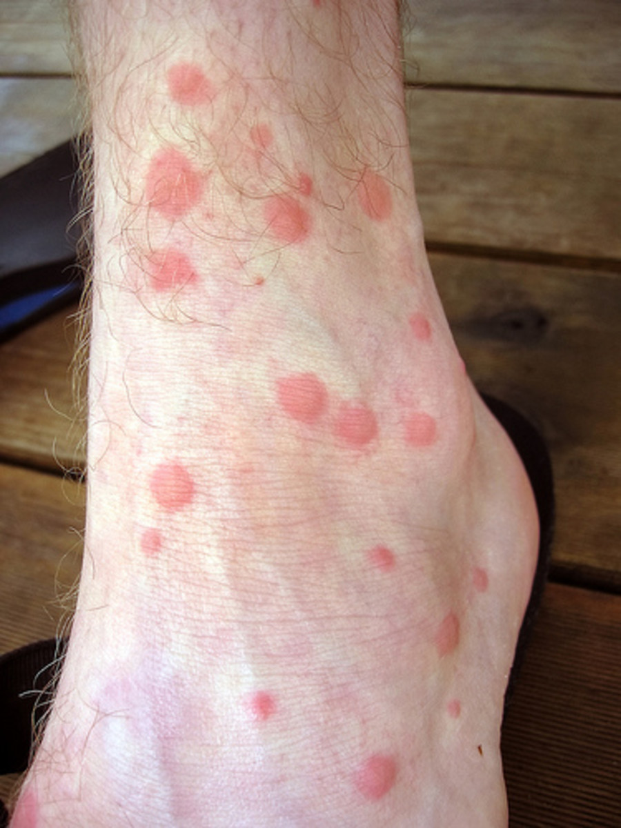 Mosquito Bites Treatment of the Itch | HubPages