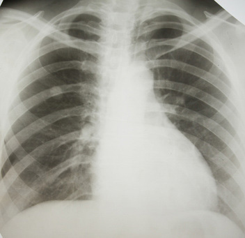 An x-ray taken of a patient with mesothelioma cancer.