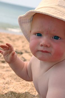 burnt baby