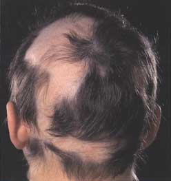 alopecia disorder pic