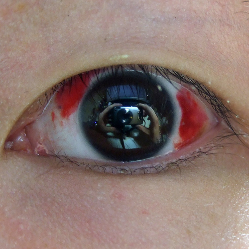 An eye after LASIK surgery.