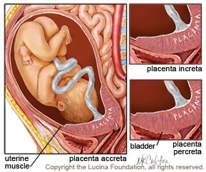 Placenta accreta